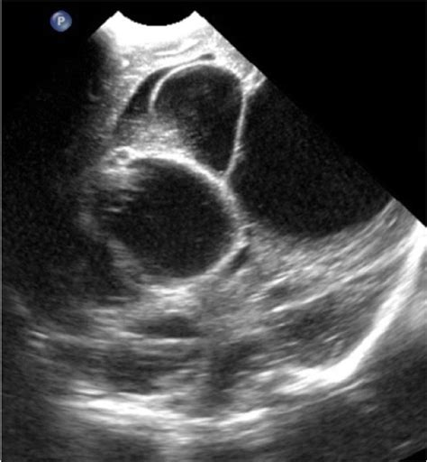 Ultrasound Image Of An Infant Showing Multiple Loculations And Dilated