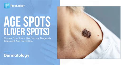 Age Spots Liver Spots Causes Symptoms Risk Factors Diagnosis