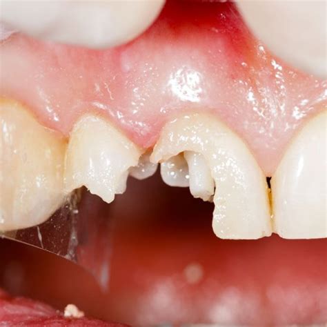 Broken Tooth Extraction Procedure How Its Done Steps