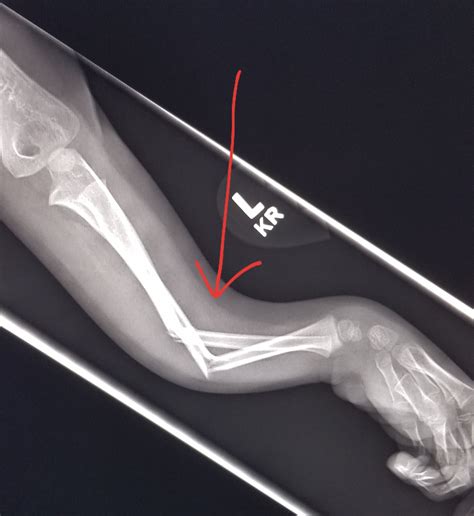 Forearm Xray Angulated Fractures In S Child Who Fell Out Of A Tree