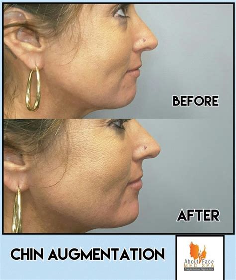 Nonsurgical Chin Lift Using Fillers About Face Med Spa