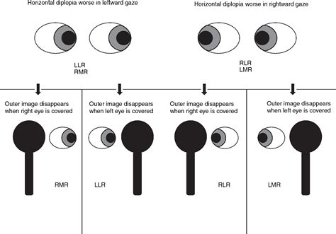 Diplopia