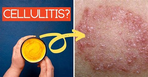 Treating Cellulitis At Home 7 Home Remedies For Cellulitis