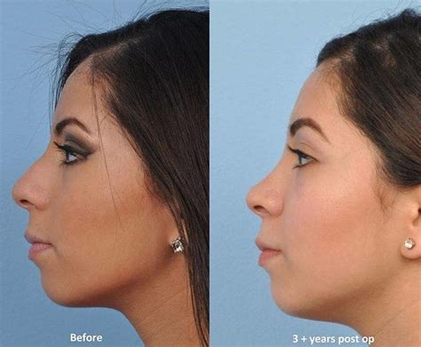 Nose Bump Surgery Before And After 2 Rhinoplasty Cost Pics