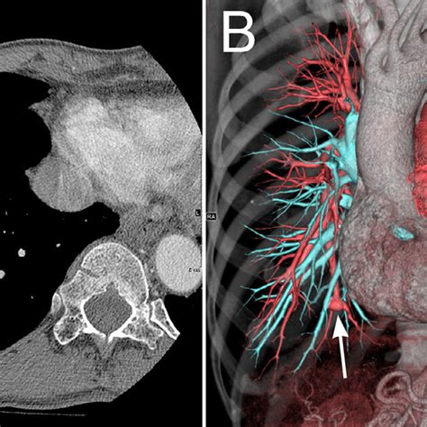 Contrast Enhanced Computed Tomography Ct Before Transcatheter