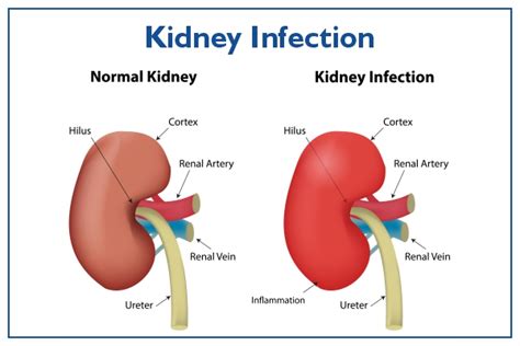 Kidney Infection Symptoms Dos And Donts Treatment Causes And Risks