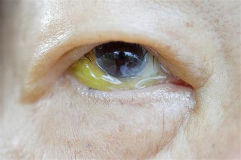 Por qué tengo una mancha amarilla en el ojo Causas y tratamiento