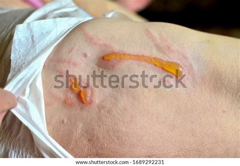 Decubitus Ulcer Pressure Ulcers On Skin Stock Photo Edit Now 1689292231