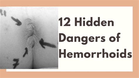 Not all polyps become cancerous. 12 Hidden Dangers of Hemorrhoids-Colon cancer ...