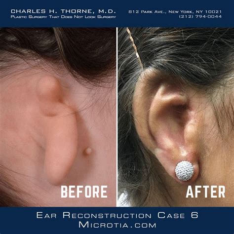 Microtia Ear Reconstruction Case Before And After