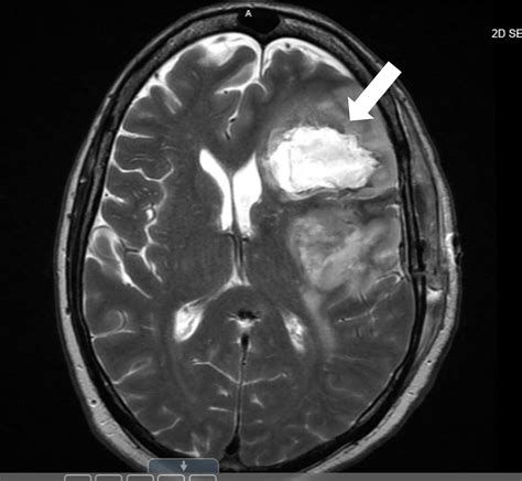 Cureus Ischemic Stroke After Tumor Resection In A Patient With