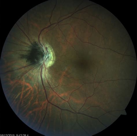 Fundus Photograph Showing An Optic Disk Melanocytoma Download