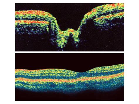 Optical Coherence Tomography Oct Retina And Optic Nerve Scan South