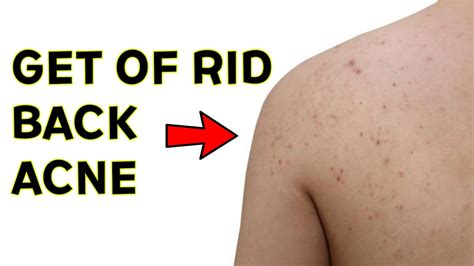 🍅 How To Get Rid Of Back Acne Naturally 3 Back Acne Remedies That