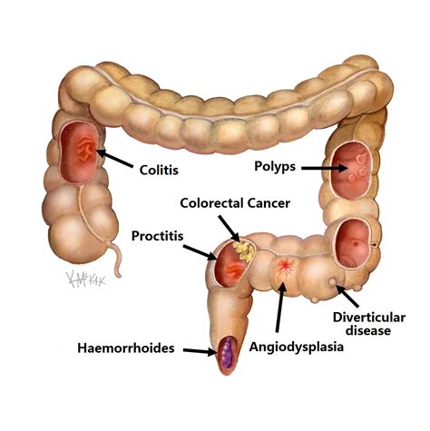 Bloody Stool Colon Cancer