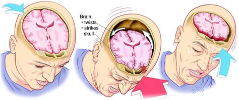What Is Concussion Queensland Brain Institute University Of Queensland
