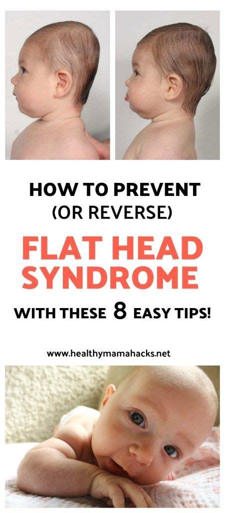 How To Prevent Or Reverse Flat Head Syndrome With These 8 Easy Tips