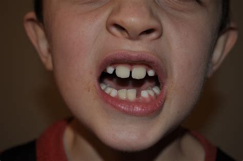How to pull a front tooth out adults. SixIowaSmiths: Ammon's new smile