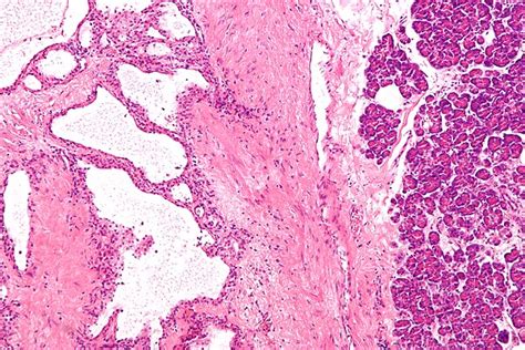 Serous Cystadenoma Of The Pancreas Libre Pathology