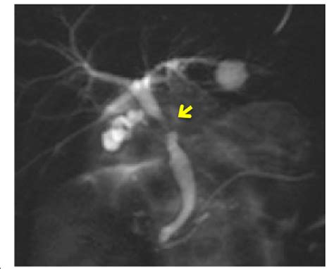 A Mrcp Image Shows Sever Stenosis In The Middle Common Bile Duct