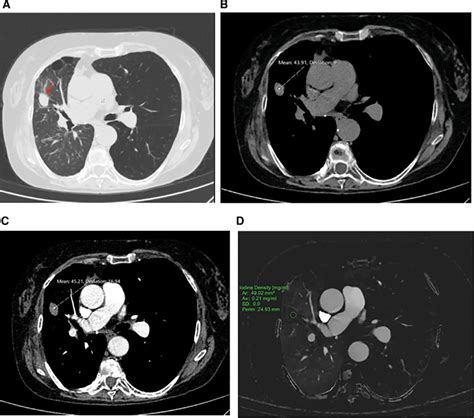 Axial Lung Window A And Soft Tissue B Conventional Ct Images