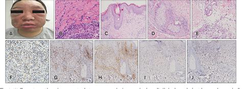 Figure 1 From A Case Of Extranodal Natural Killert Cell Lymphoma Nasal Type With