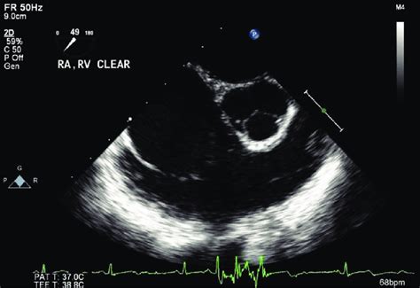 A Mid Esophageal Right Ventricular Inflow Outflow View Showing The