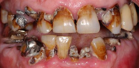 It is called a remineralization process that avoids the formation of a cavity. 15 Things That Are Better Than Donald Trump