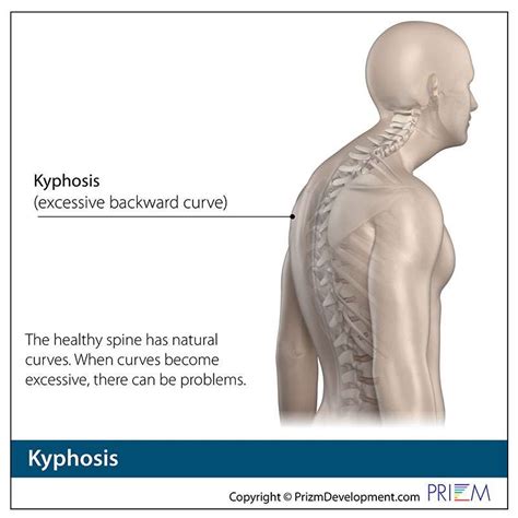 Kyphosis Treatment Reno And Carson City Swift Institute