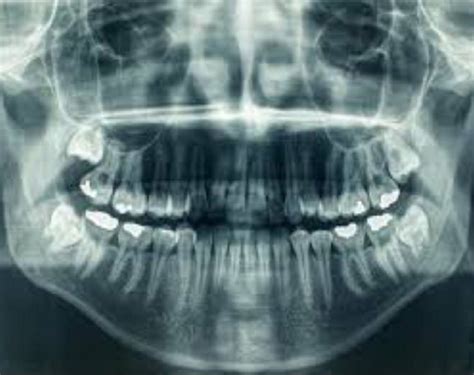Dental Radiography Buddha Dental Tree