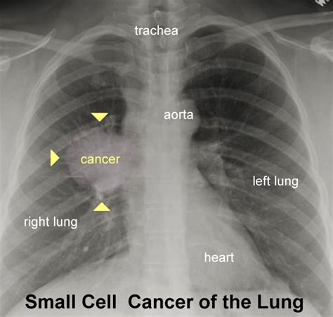 Cancerous X Ray Of Cancerous Lung