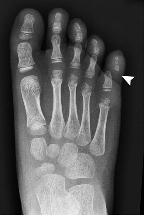 Post Traumatic Toe Deformity In A Child The Bmj