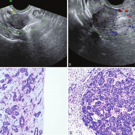 A Solid Cystic Hypoechoic Adnexal Mass B Sagittal Enhanced