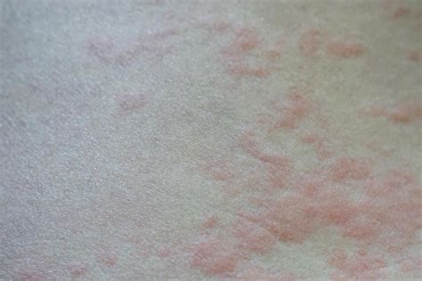 Effective Ways To Get Rid Of Hives Home Remedies For Hives Hives