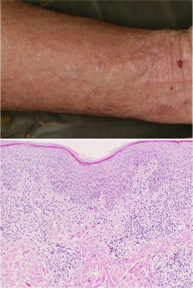 Clinical And Pathological Features Of Lichenification Of Skin In Atopic