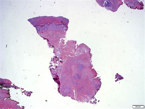 Pathology Outlines Rheumatoid Rheumatic Nodules