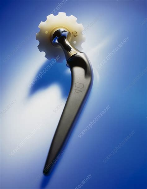 Prosthetic Hip Artificial Hip Joint Stock Image M6000164