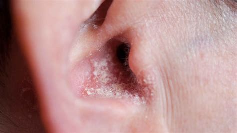 Psoriasis In The Ear Symptoms Treatment And Prevention Dermeleve
