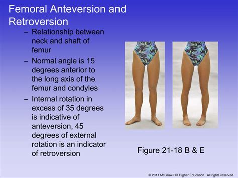 Femoral Anteversion And Retroversion