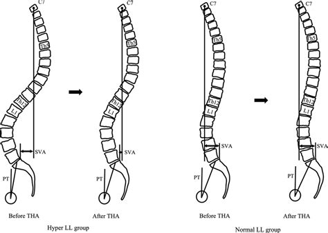Changes In Sagittal Spinal Alignment Between Patients With Hyper Ll And