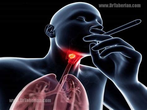 Throat Cancer Laryngeal Cancer Symptoms Causes Treatment