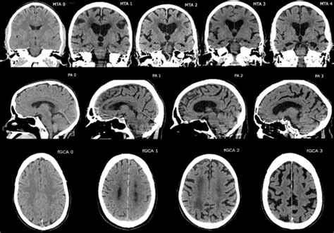 Neuroradiology And Its Role In Neurodegenerative Diseases