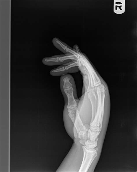 X Ray Of Man With A Crush Injury To Hand Journal Of