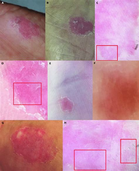 Clinical And Dermoscopic Features A And B Cases 1 And 2 Atrophic Download Scientific