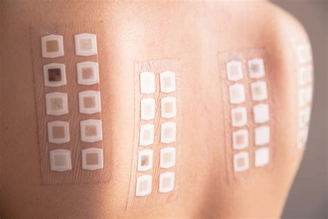 Patch Testing | Allergen Skin Testing | Epiphany Dermatology