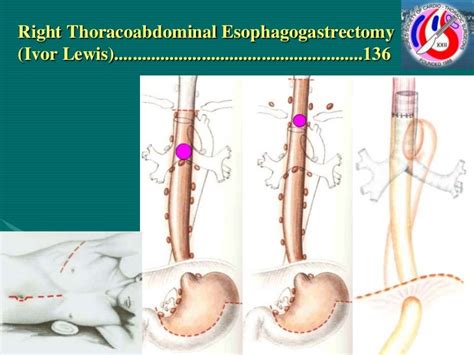 Kshivets O Esophageal And Cardioesophageal Surgery