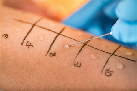 Prick Test Allergy Testing Test Procedure And Costs