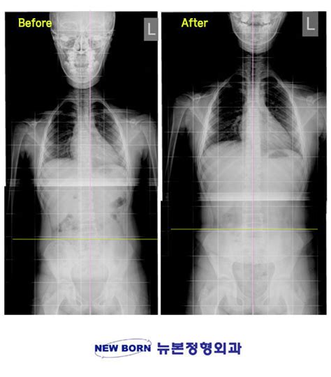 골반 비대칭, 척추측만증, 다리길이차이) 교정 전/후