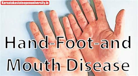 Hand Foot And Mouth Disease Causes Symptoms Diagnosis And Treatment