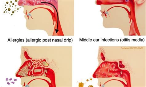 what is post nasal drip what are the common symptoms